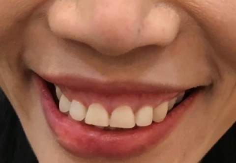 Cắt Lợi Là Gì? Những Điều Cần Biết Về Cắt Lợi